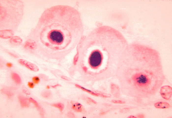 File:Histopathology of cytomegalovirus infection of kidney - PHIL 09G0036 lores.jpg