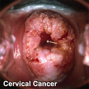 File:Cervical cancer.jpg
