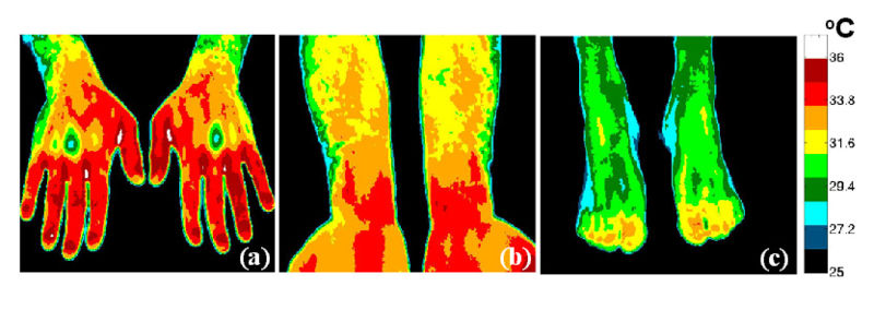 File:Normal extremity thermographic image.jpg