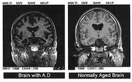 Alzheimers disease - MRI.jpg