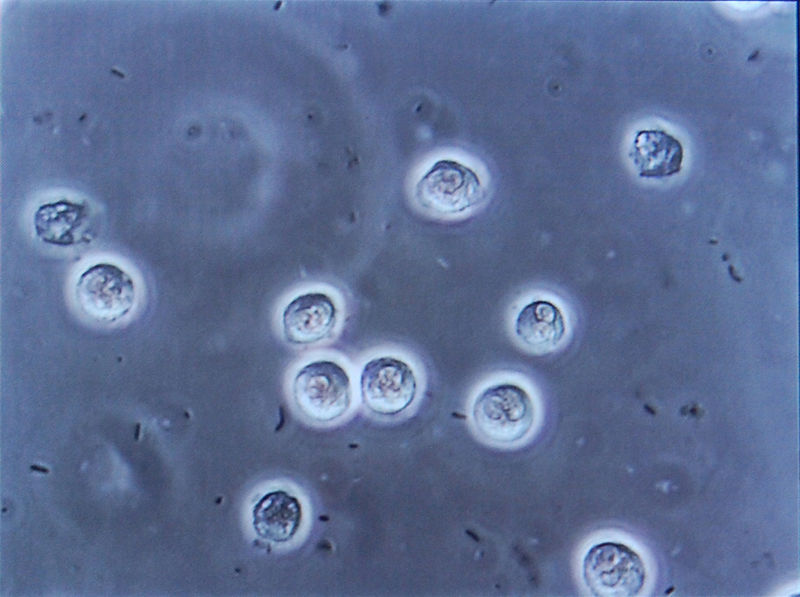 File:Multiple rod-shaped bacteria between white blood cells of patient with urinary tract infection.jpg