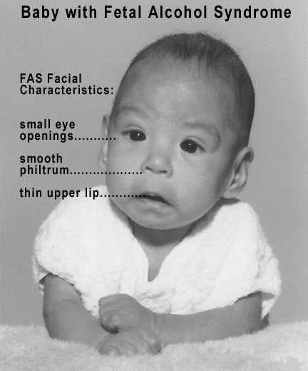 File:Baby with FAS.jpg
