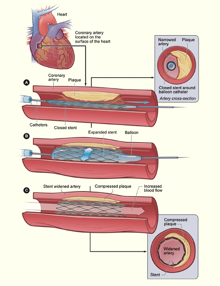 File:Stent placement.gif