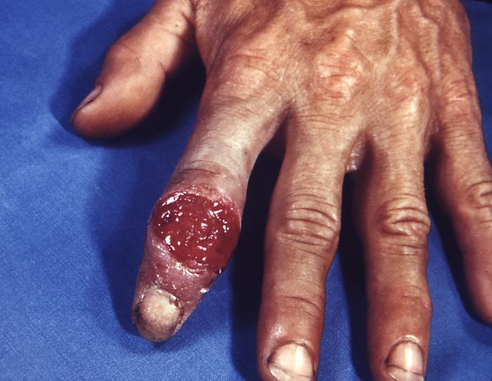 File:Extragenital syphilitic chancre of the left index finger PHIL 4147 lores.jpg