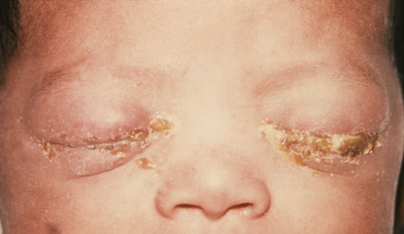 File:Gonococcal ophthalmia neonatorum.jpg