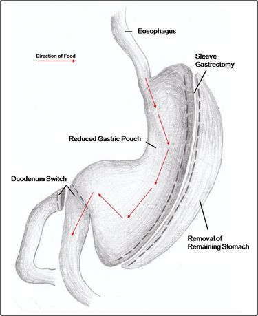 Bariatric Surgery - Citizendium