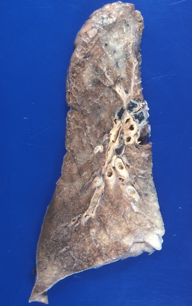 File:Normal formalin-perfused lung obtained at autopsy.png