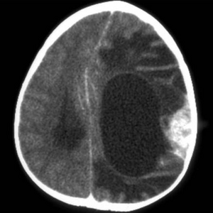Brain tumor-CT.png